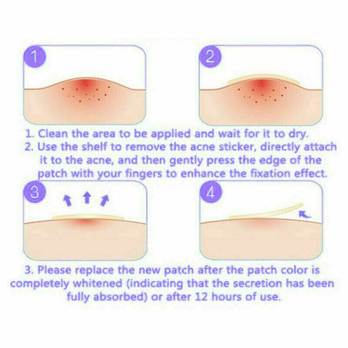 48 PCS Skin Tag & Acne Patch - Esellertree